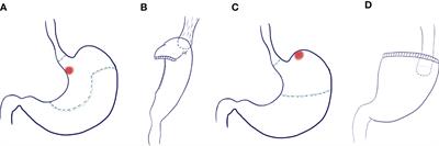 Clinical effect and follow-up of laparoscopic radical proximal gastrectomy for upper gastric carcinoma